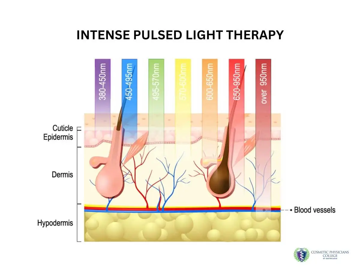 Illustration showing skin layers and light wavelengths used in Intense Pulsed Light Therapy for hair and skin treatment.