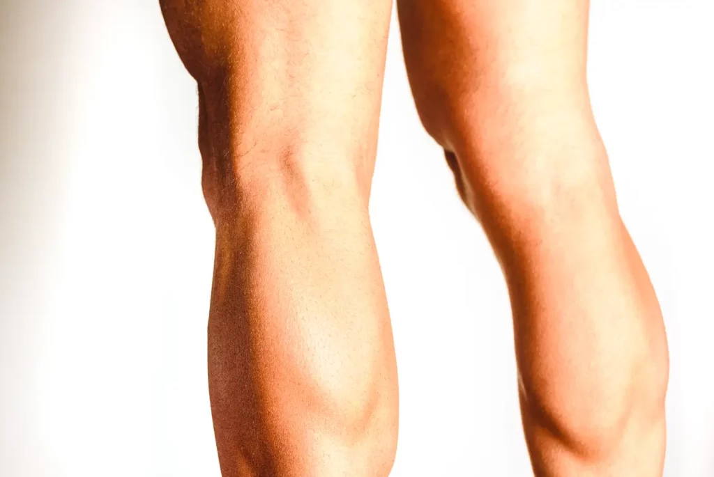 Male legs showing visible veins before Sclerotherapy treatment.